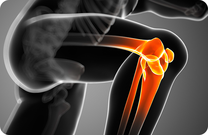 관절 질환 이미지2