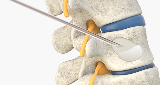 척추골절 추세성형술 사진
