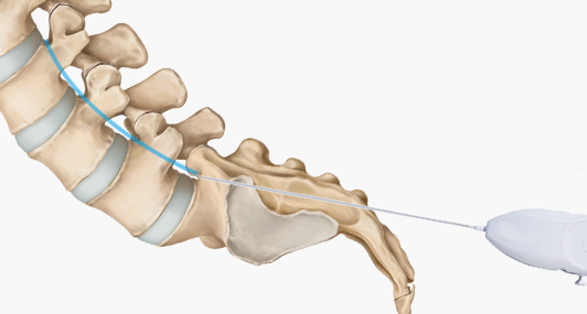 신경성형술(PEN) 사진
